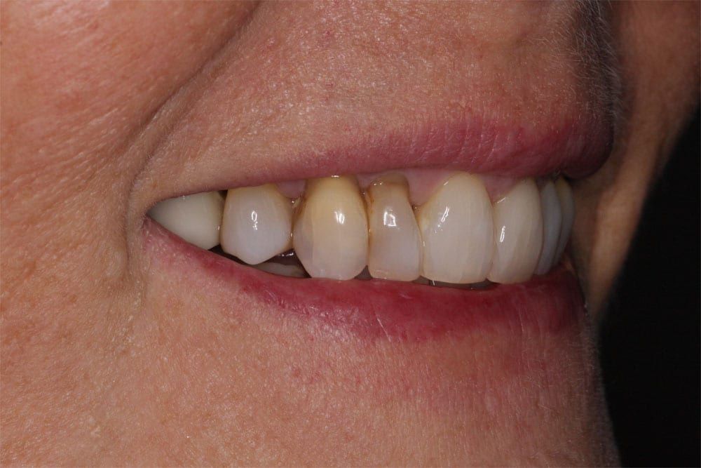 before and after photo (close shot)