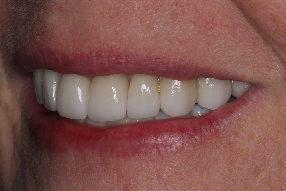 before and after photo (close shot)