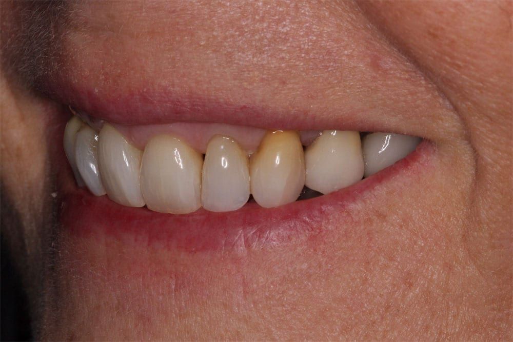 before and after photo (close shot)