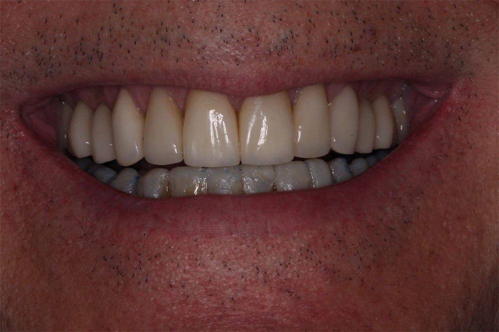 before and after photo (close shot)