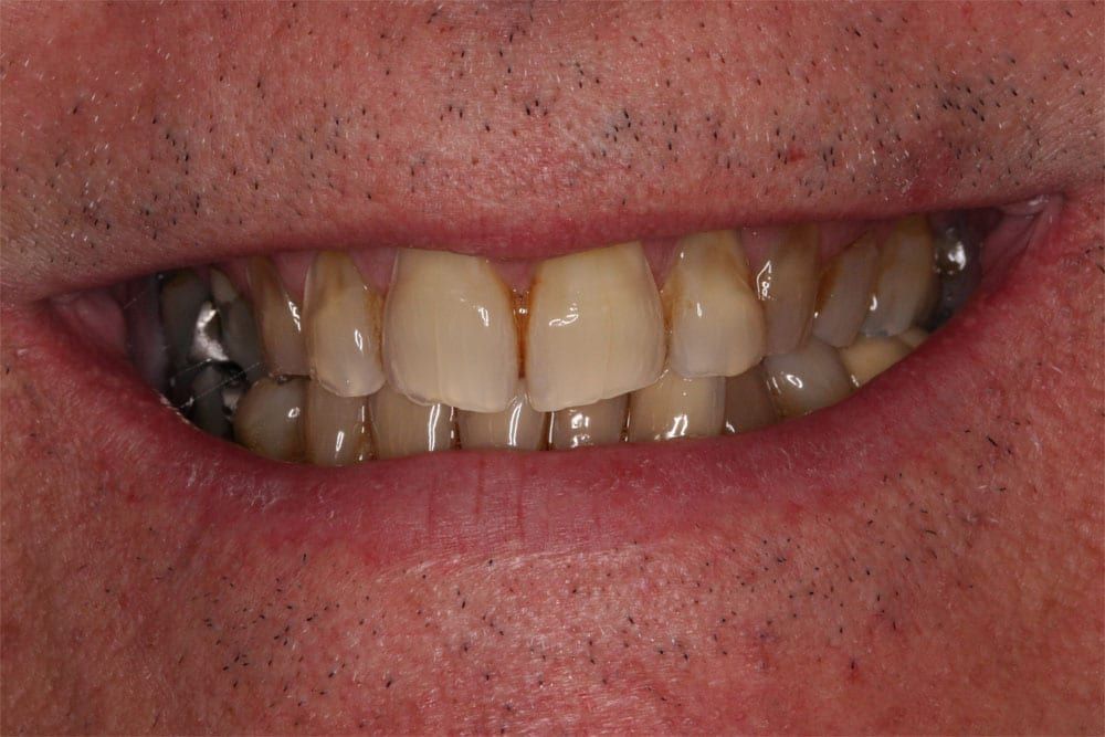 before and after photo (close shot)