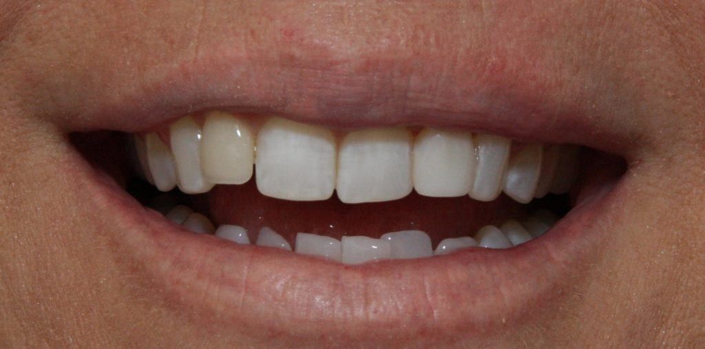 before and after photo (close shot)