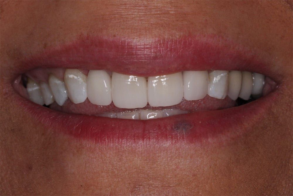 before and after photo (close shot)