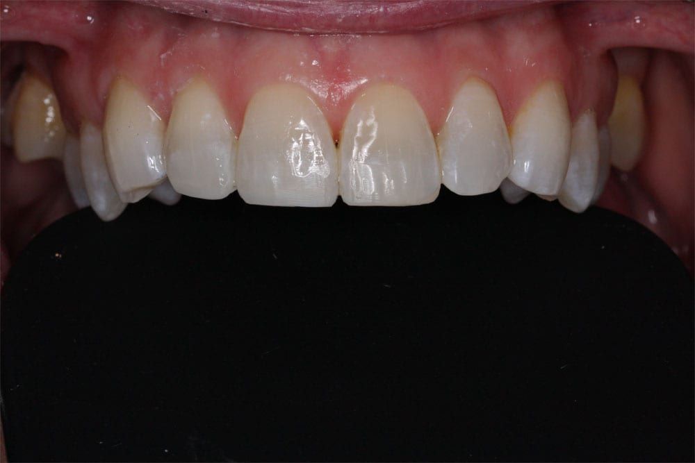 before and after photo (close shot)