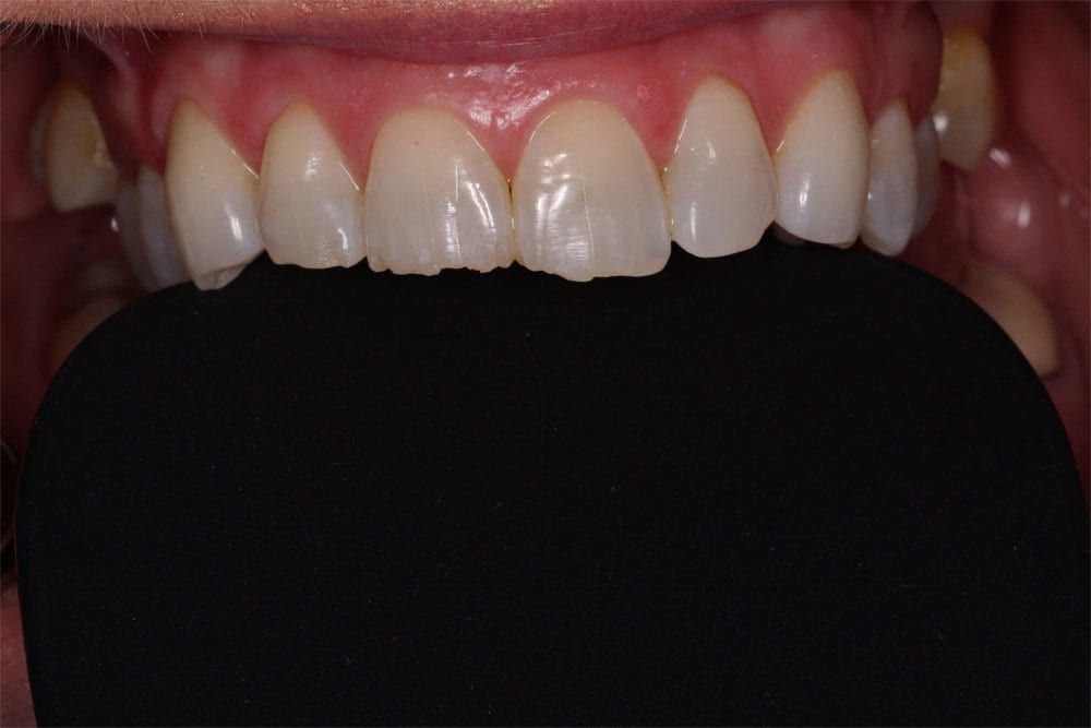 before and after photo (close shot)