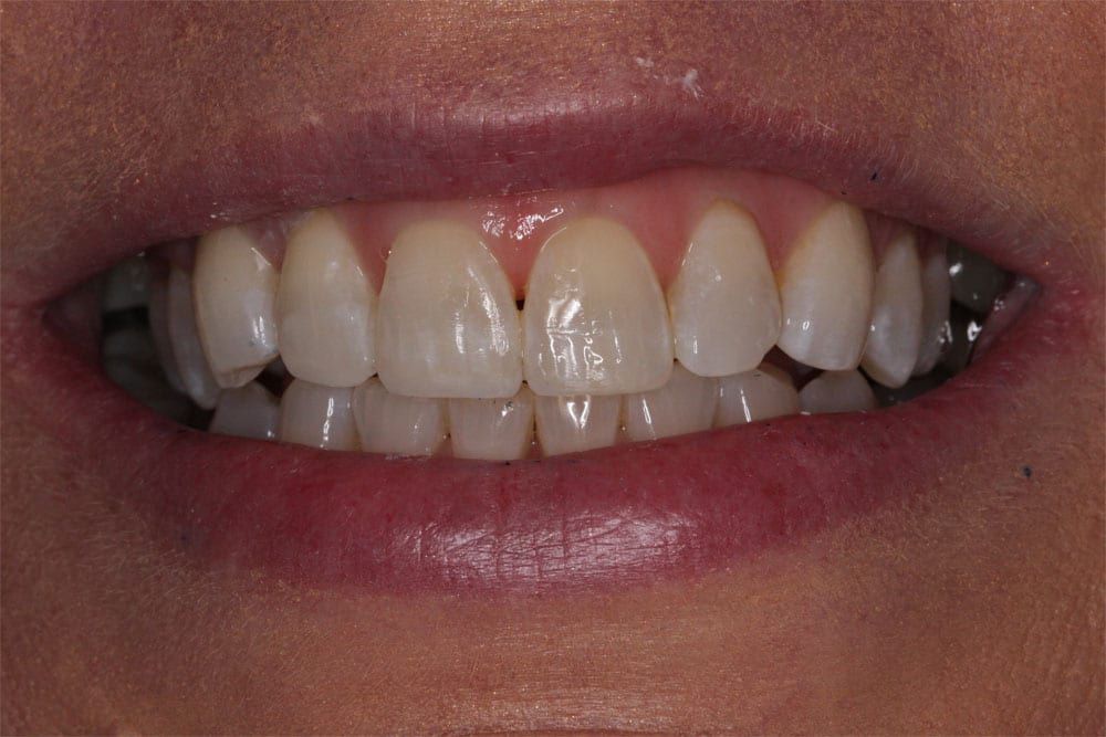 before and after photo (close shot)