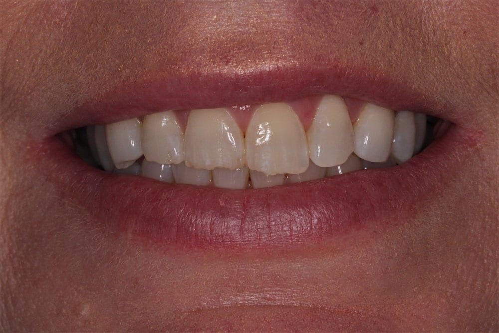 before and after photo (close shot)
