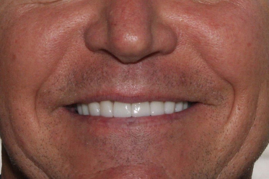 before and after photo (close shot)