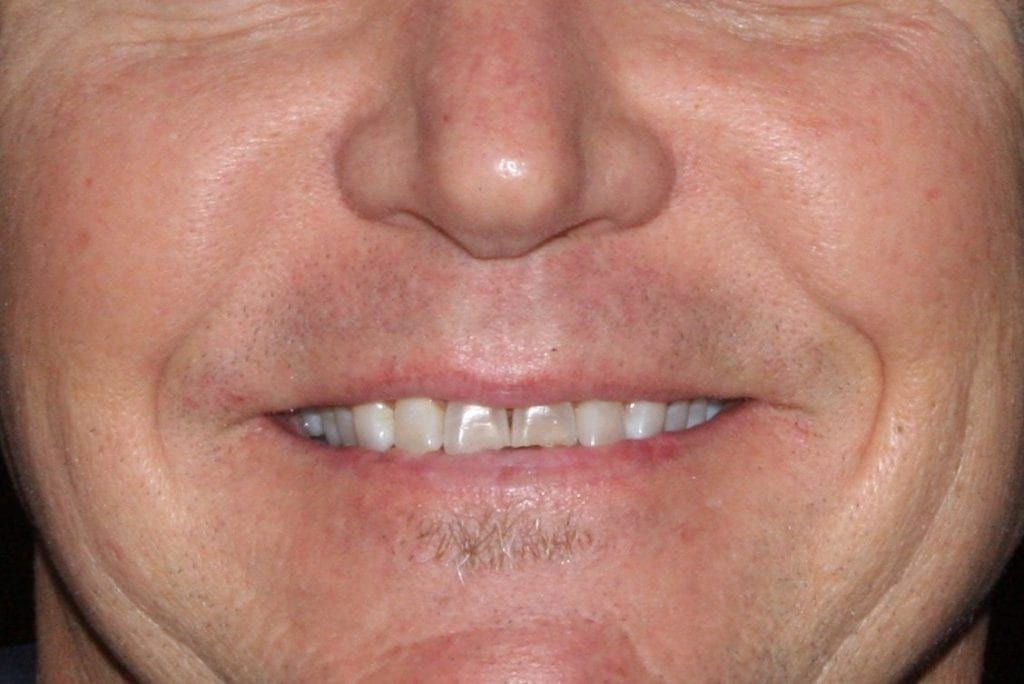 before and after photo (close shot)