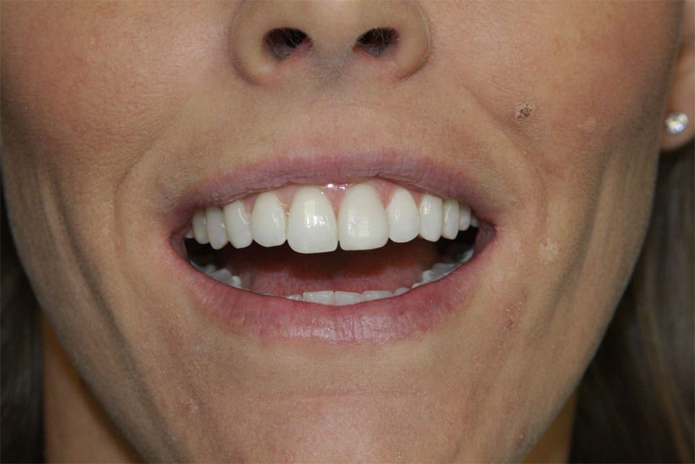 before and after photo (close shot)