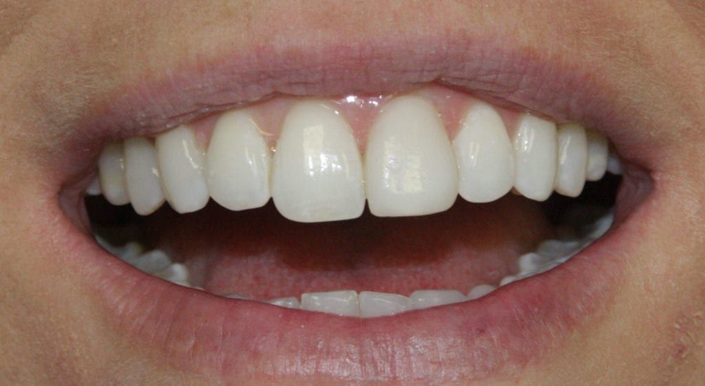 before and after photo (close shot)