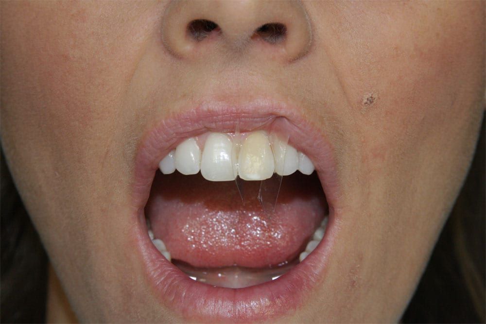 before and after photo (close shot)
