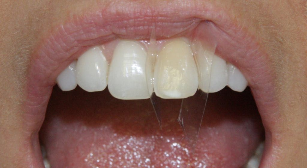 before and after photo (close shot)