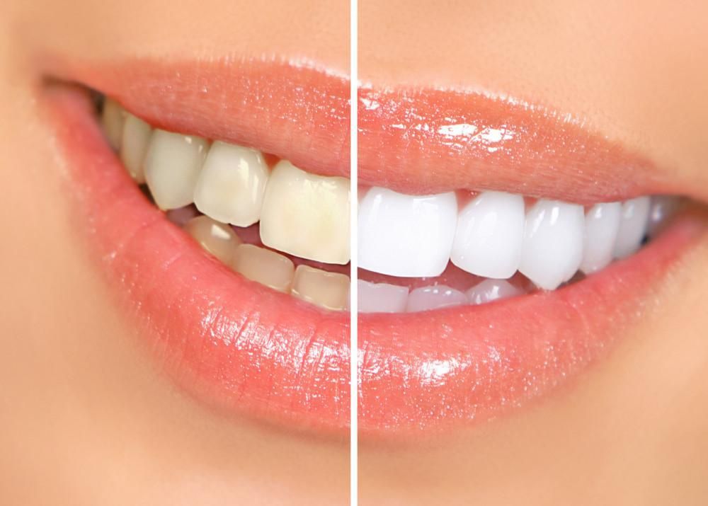 before and after closeup teeth whitening