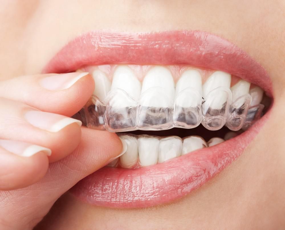 closeup teeth with clear aligners