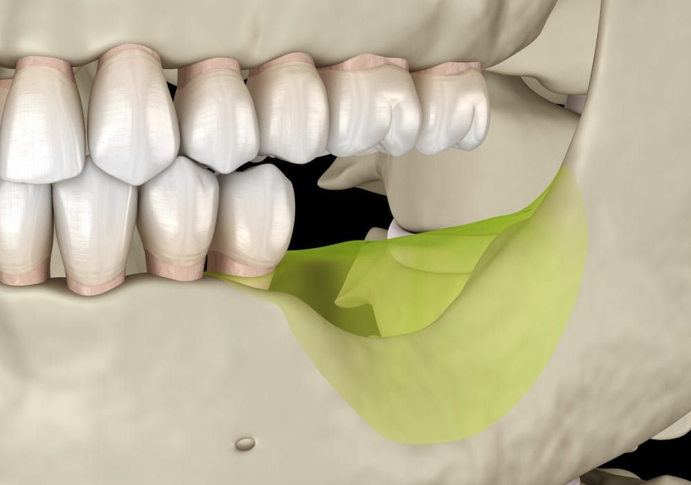 Bone loss in mandible