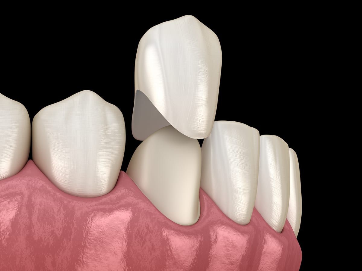 care-for-your-teeth-with-porcelain-crowns-at-somerset-smiles