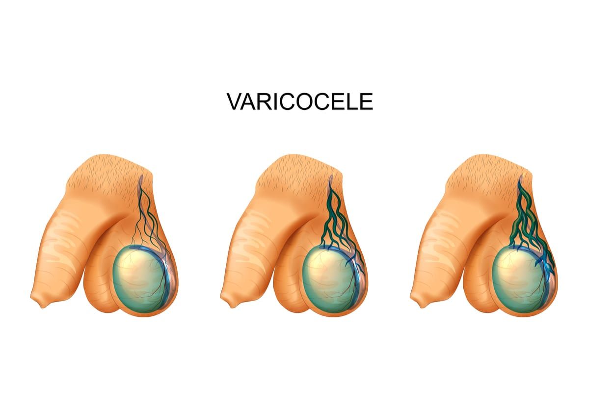 Varicocelectomy Ricardo Gonzalez M D 