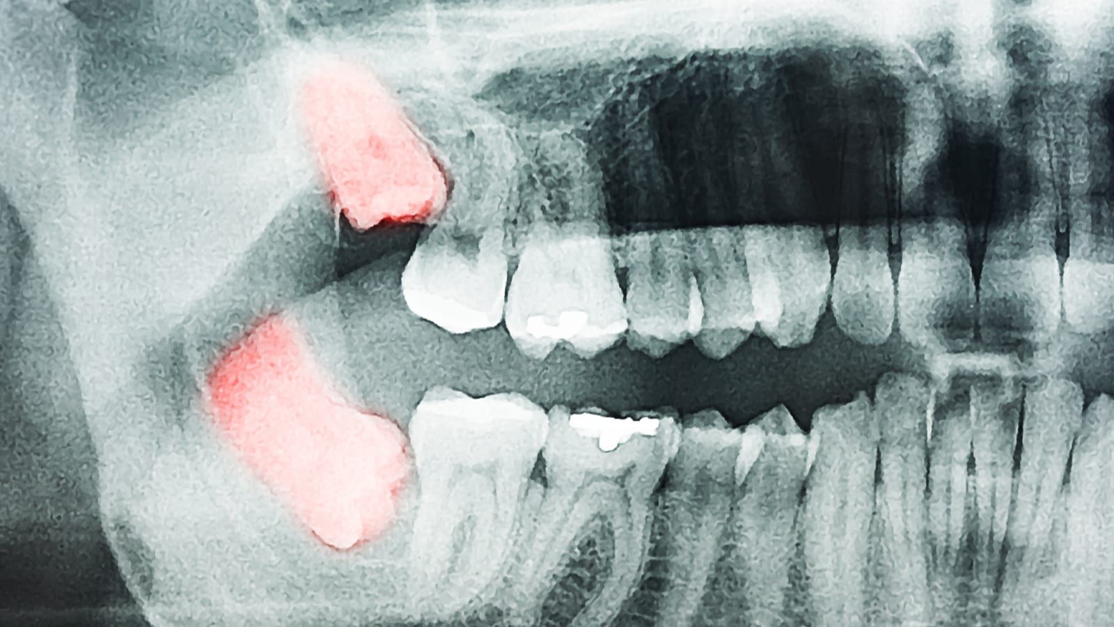 X-Ray of Impacted Wisdom Teeth With Wisdom Teeth Highlighted in Red