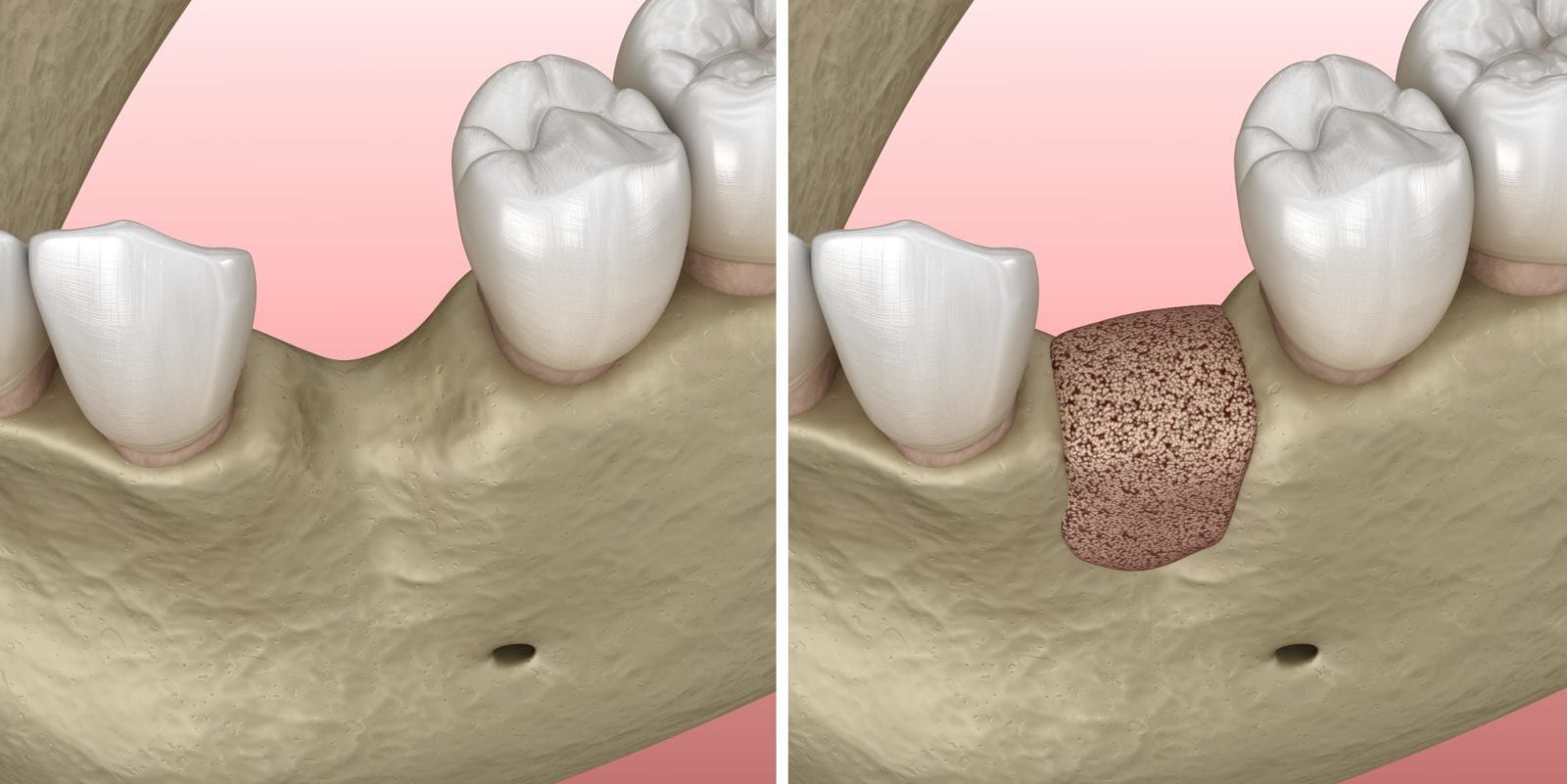 before and after bone graft